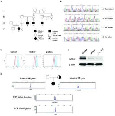 Case Report: Wiskott-Aldrich Syndrome Caused by Extremely Skewed X-Chromosome Inactivation in a Chinese Girl